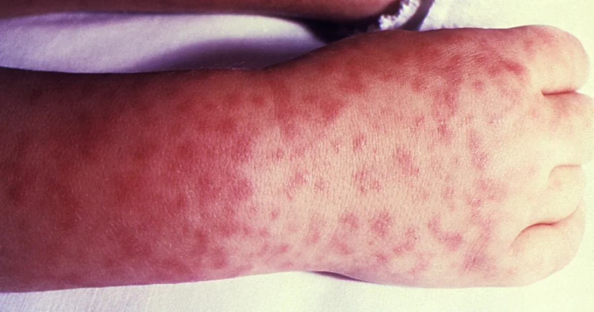 Tragedia en Ensenada: fallece niña de 8 años por rickettsiosis transmitida por garrapatas