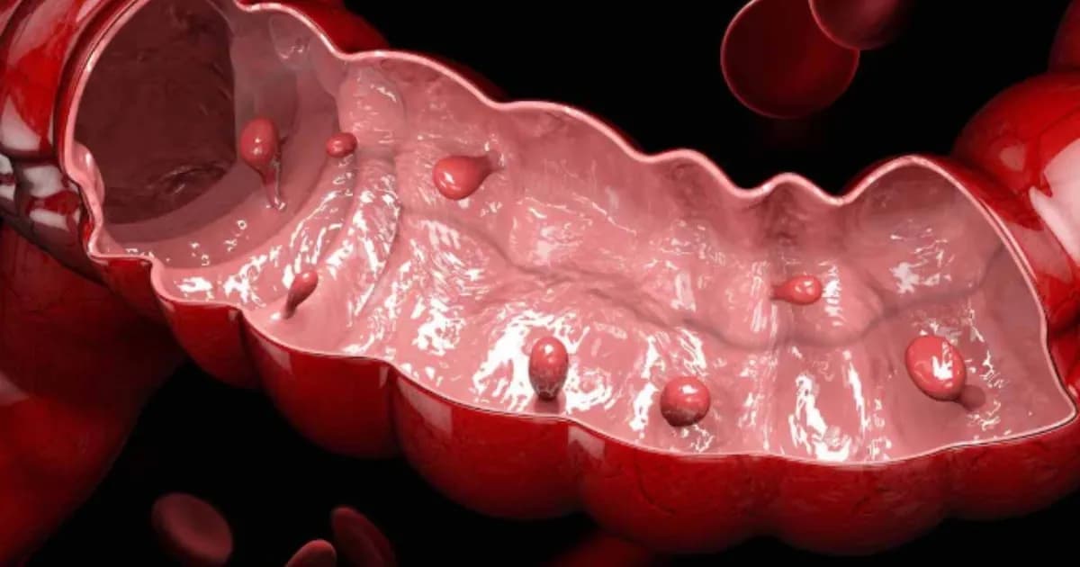 Detección temprana de pólipos: clave para prevenir el cáncer de colon