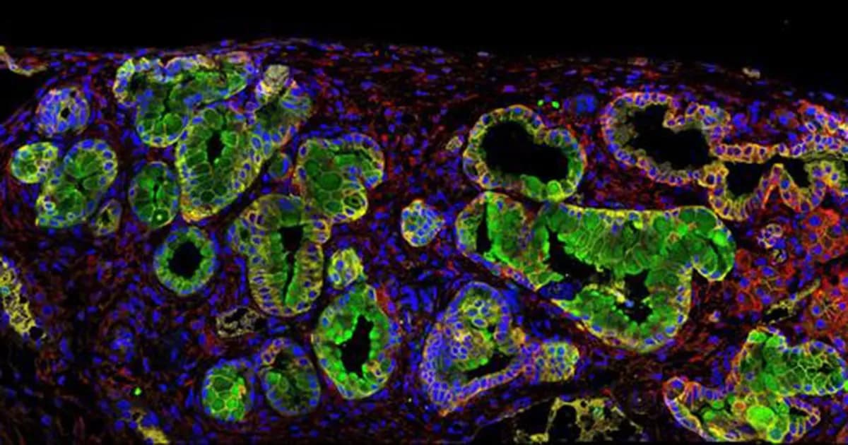 El estrés podría acelerar el avance del cáncer de páncreas, según un nuevo estudio