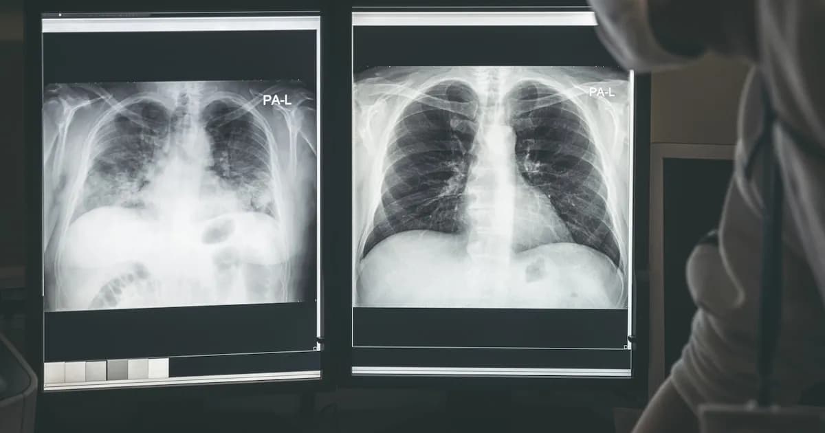 Diez señales tempranas del cáncer de pulmón que suelen ignorarse