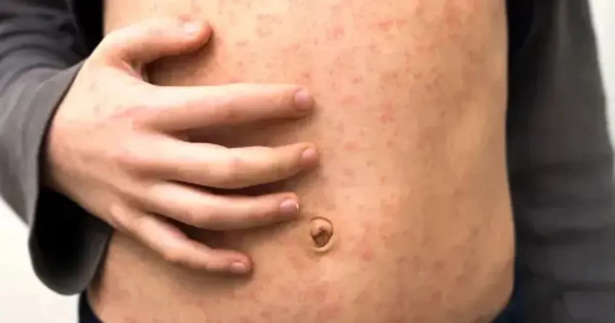 Costa Rica reporta segundo caso de sarampión y se investiga su origen