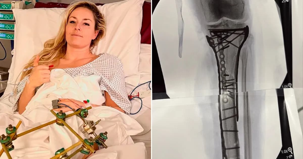 Lindsey Vonn muestra su recuperación tras cirugía tras fractura en los Juegos Olímpicos