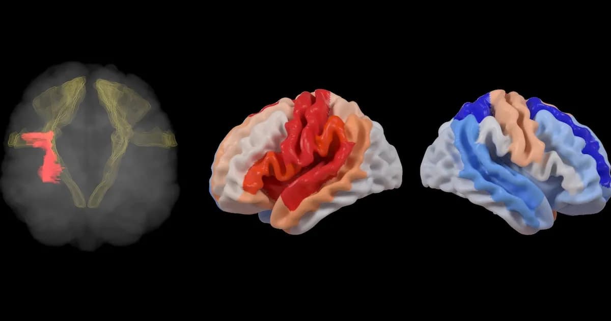 Estudio revela que el cerebro se adapta tras un ACV rejuveneciendo ciertas áreas