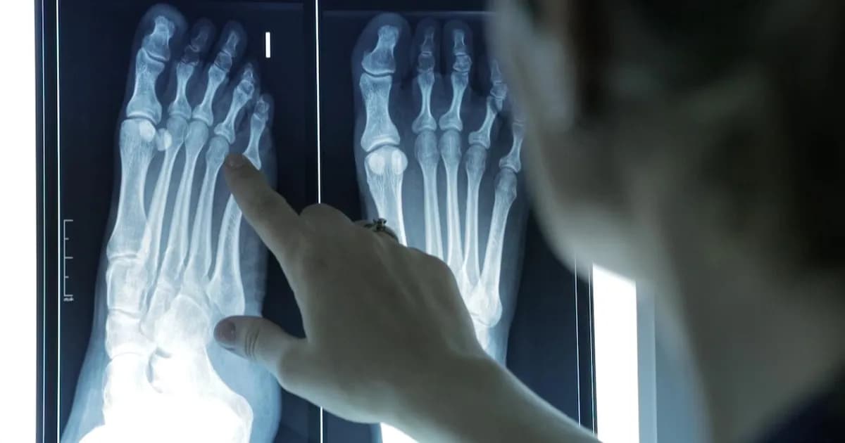 El 60% de los adultos presenta deformidades en los dedos de los pies, alertan expertos