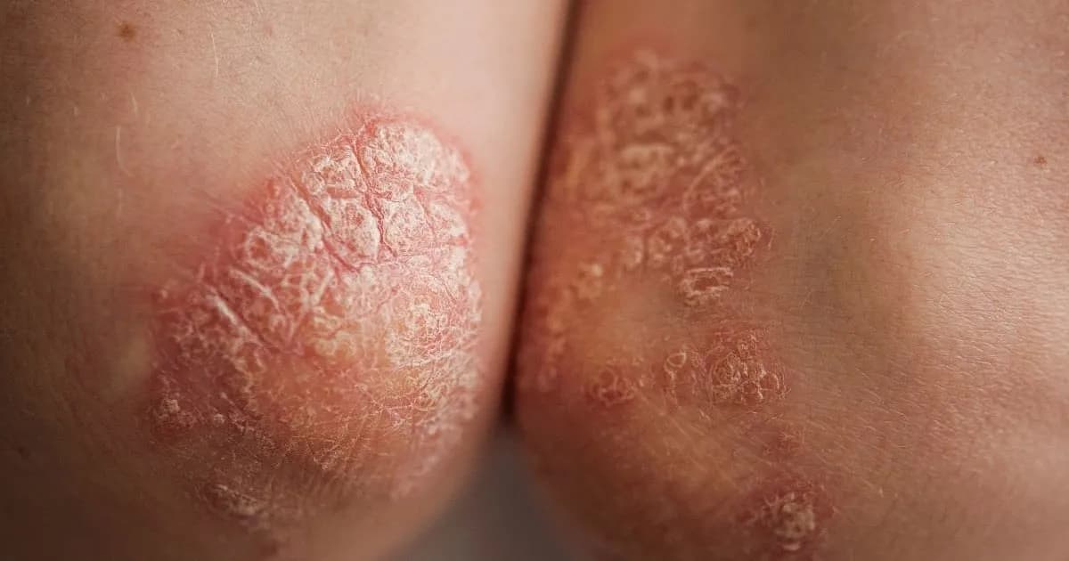 Innovadora pastilla podría transformar el manejo de la psoriasis