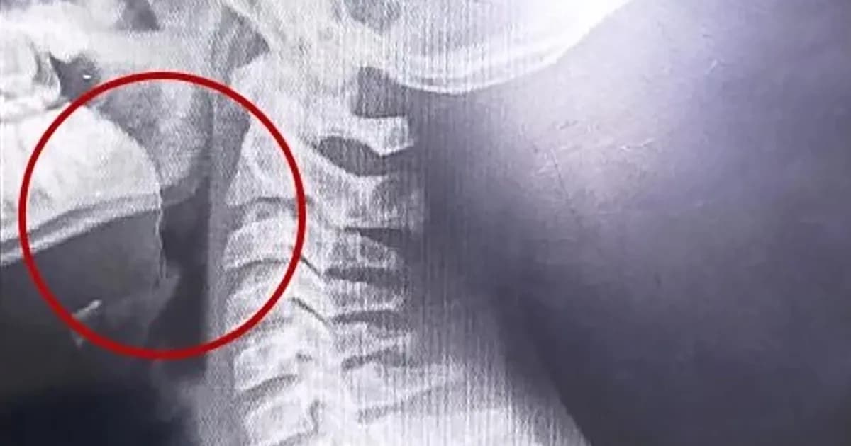 Adolescente escupe sangre tras comer galletitas: hallazgo médico sorprendente en su garganta