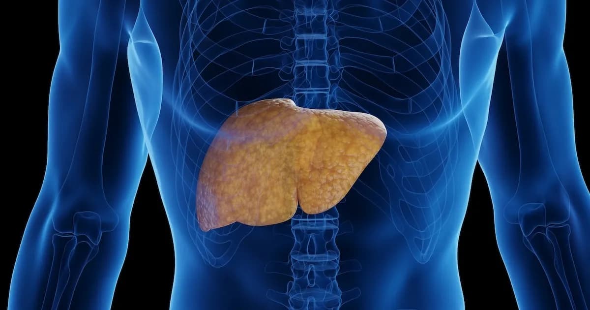 Descubren factores de riesgo metabólico para la enfermedad hepática esteatosiva