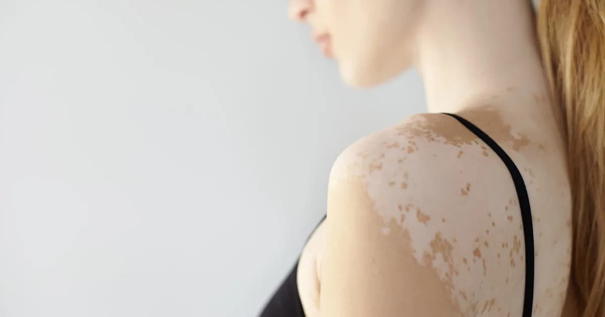 Nuevas Revelaciones sobre el Vitiligo: Diferencias Genéticas según la Edad de Inicio