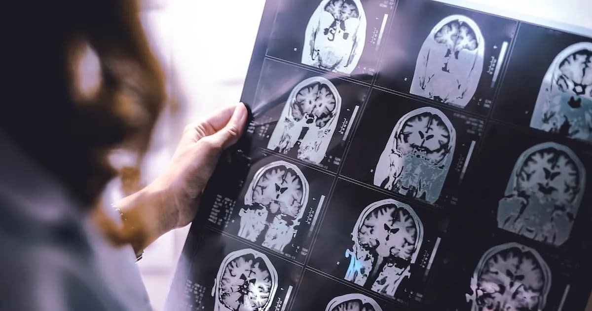 Avances en IA permiten detectar lesiones ocultas por esclerosis múltiple