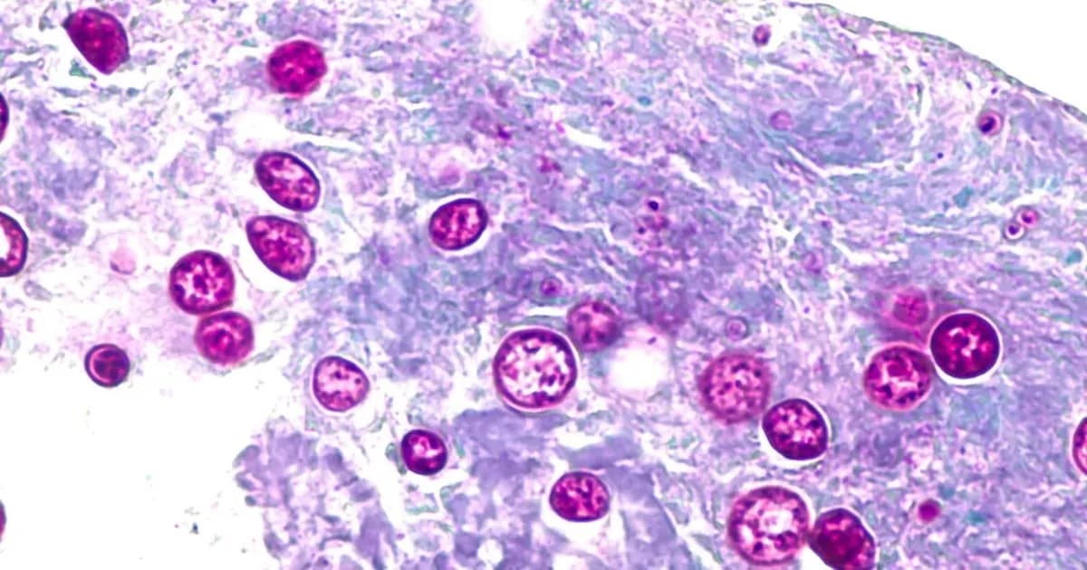 Aumento de ciclosporiasis en Florida: síntomas, prevención y recomendaciones de los expertos