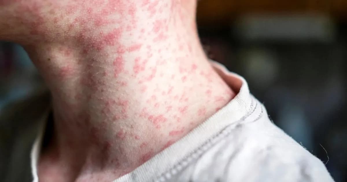 Tres casos de sarampión activan la alerta sanitaria en Colombia