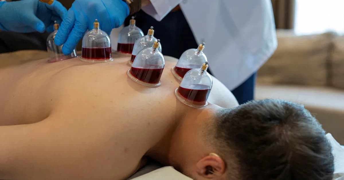 Terapia con ventosas: aplicación, beneficios y consideraciones médicas
