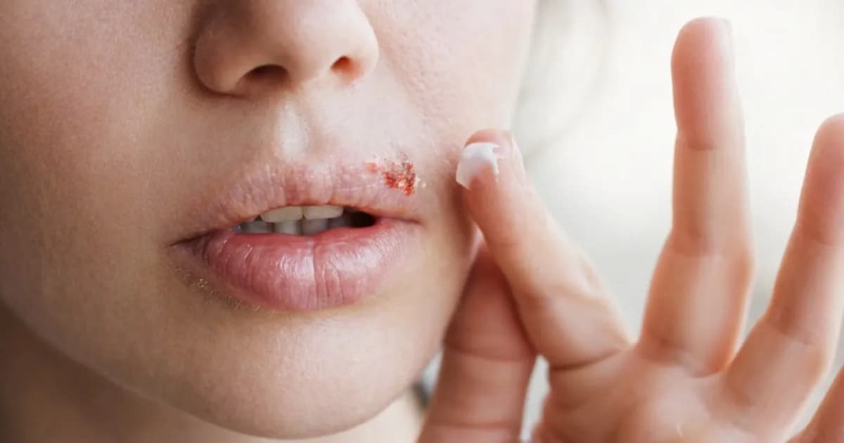 Consejos para prevenir el herpes labial de manera efectiva