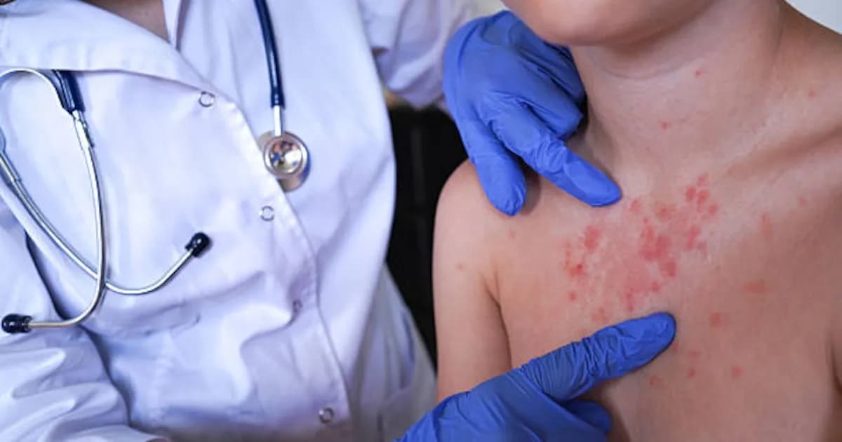 Aumento de casos de sarampión en México: 13.408 contagios confirmados