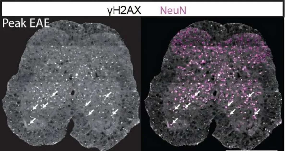 Descubren un mecanismo clave que podría transformar el tratamiento de la esclerosis múltiple