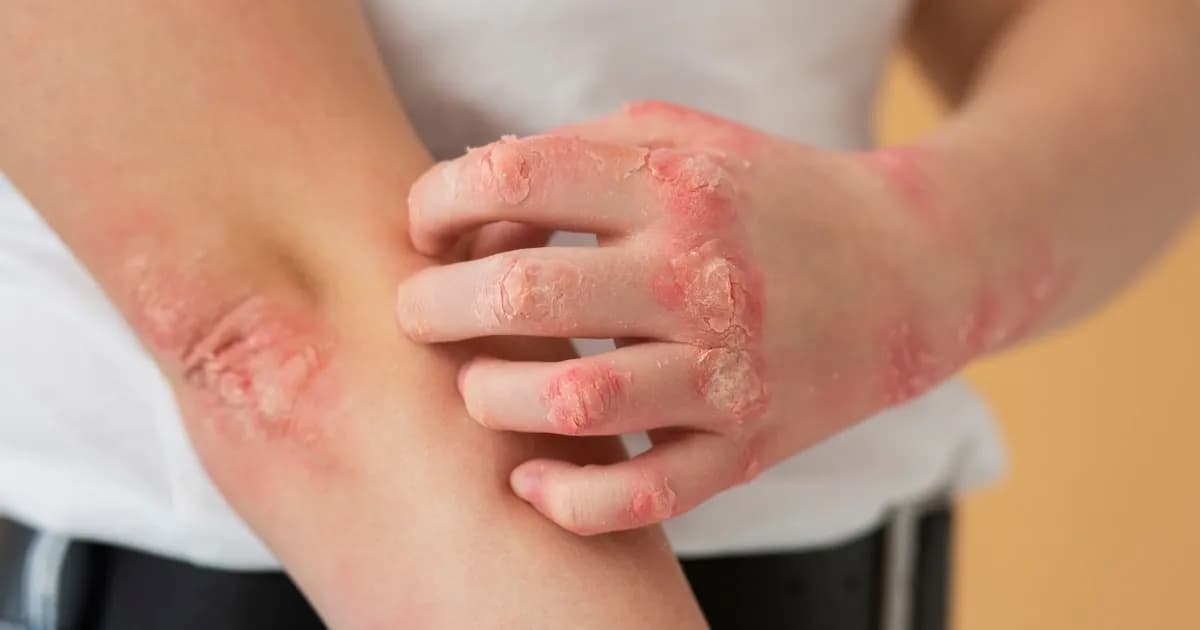 Identificando los Desencadenantes de la Urticaria Crónica: Nueve Factores Clave