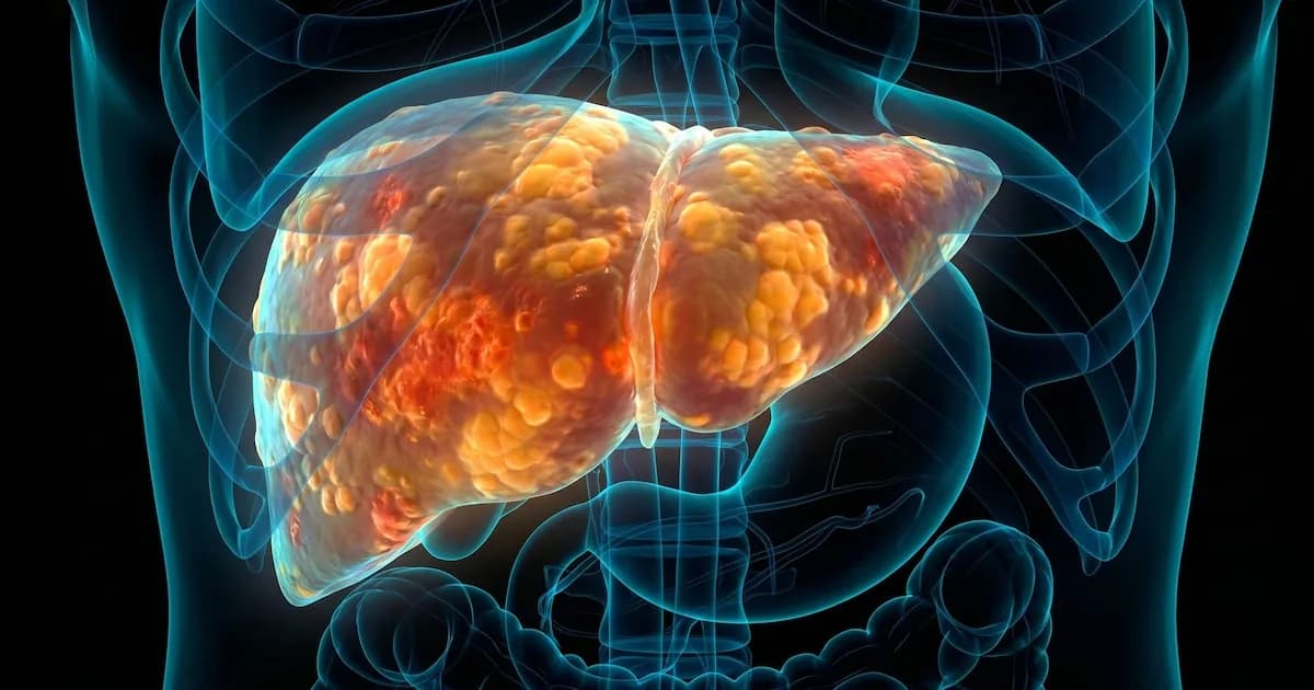 Consejos para combatir el hígado graso y mejorar la salud digestiva