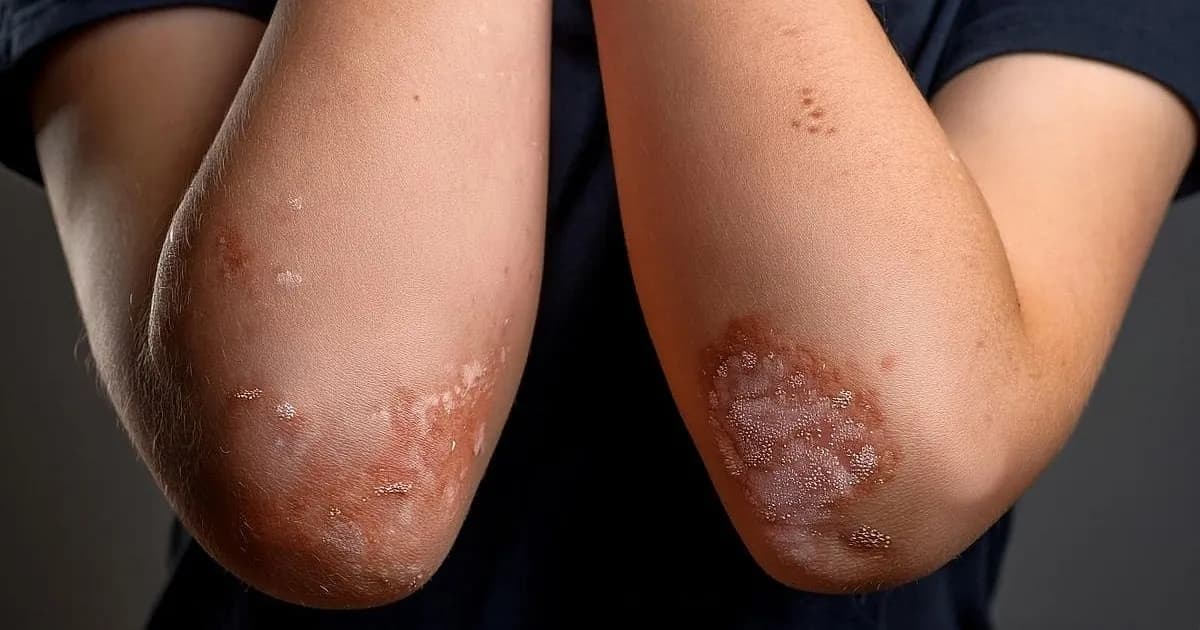 La Psoriasis y su Impacto en el Sueño: Un Estudio Revelador