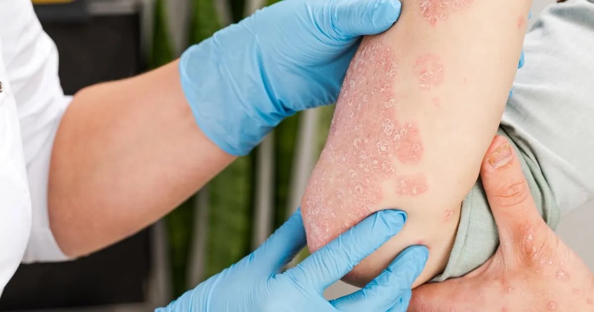 La detección temprana de la psoriasis pustulosa, clave para evitar complicaciones