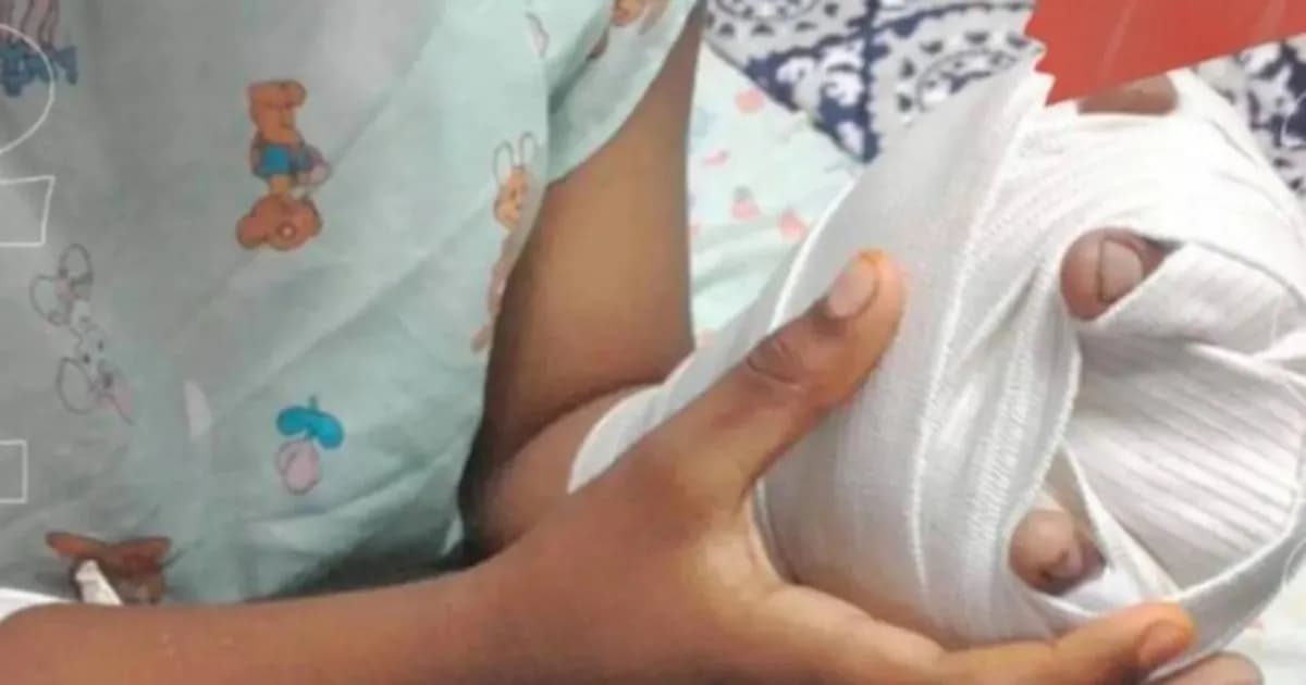 Los niños menores de nueve años son los más afectados por quemaduras en El Salvador