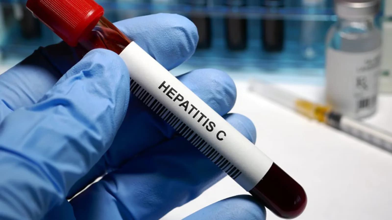 La hepatitis C activa es cuatro veces más frecuente en personas con trastorno mental grave