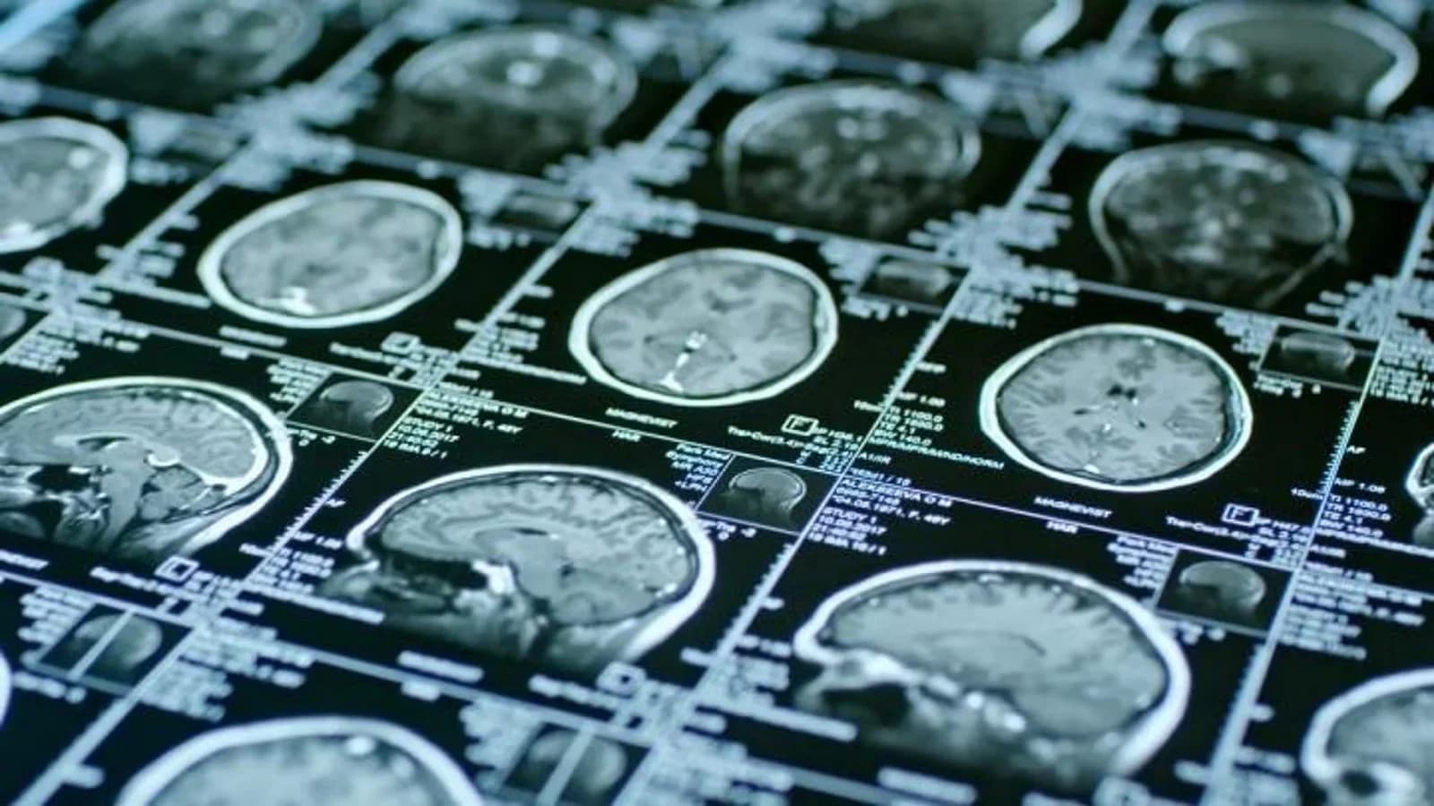 La espera para una consulta de neurología alcanza los 109 días en España