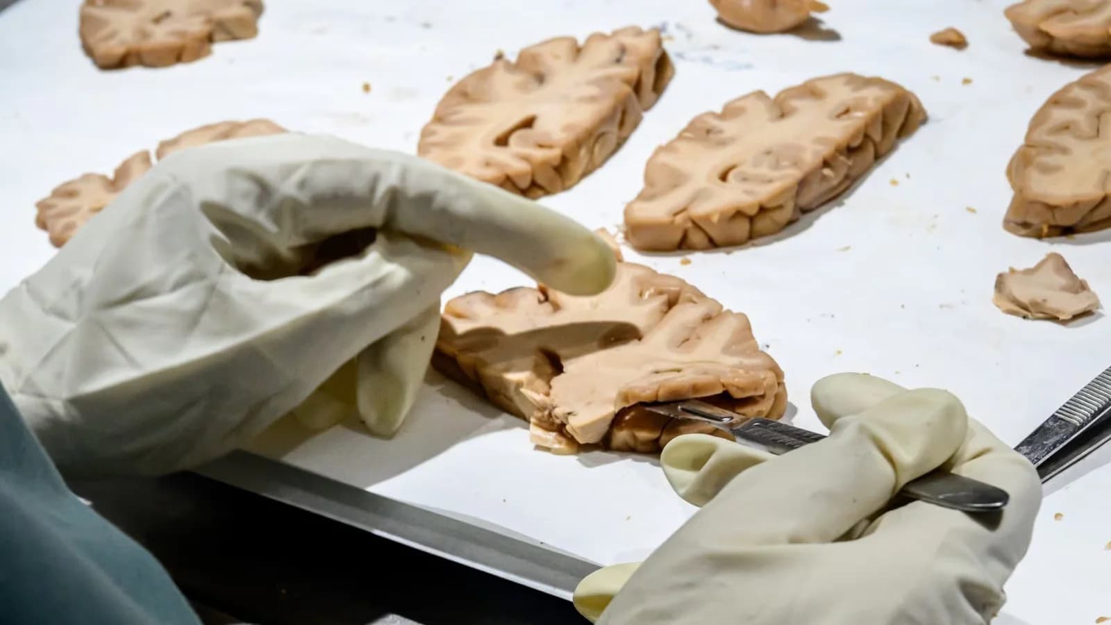 Un análisis de sangre estima el riesgo de Alzheimer hasta diez años antes